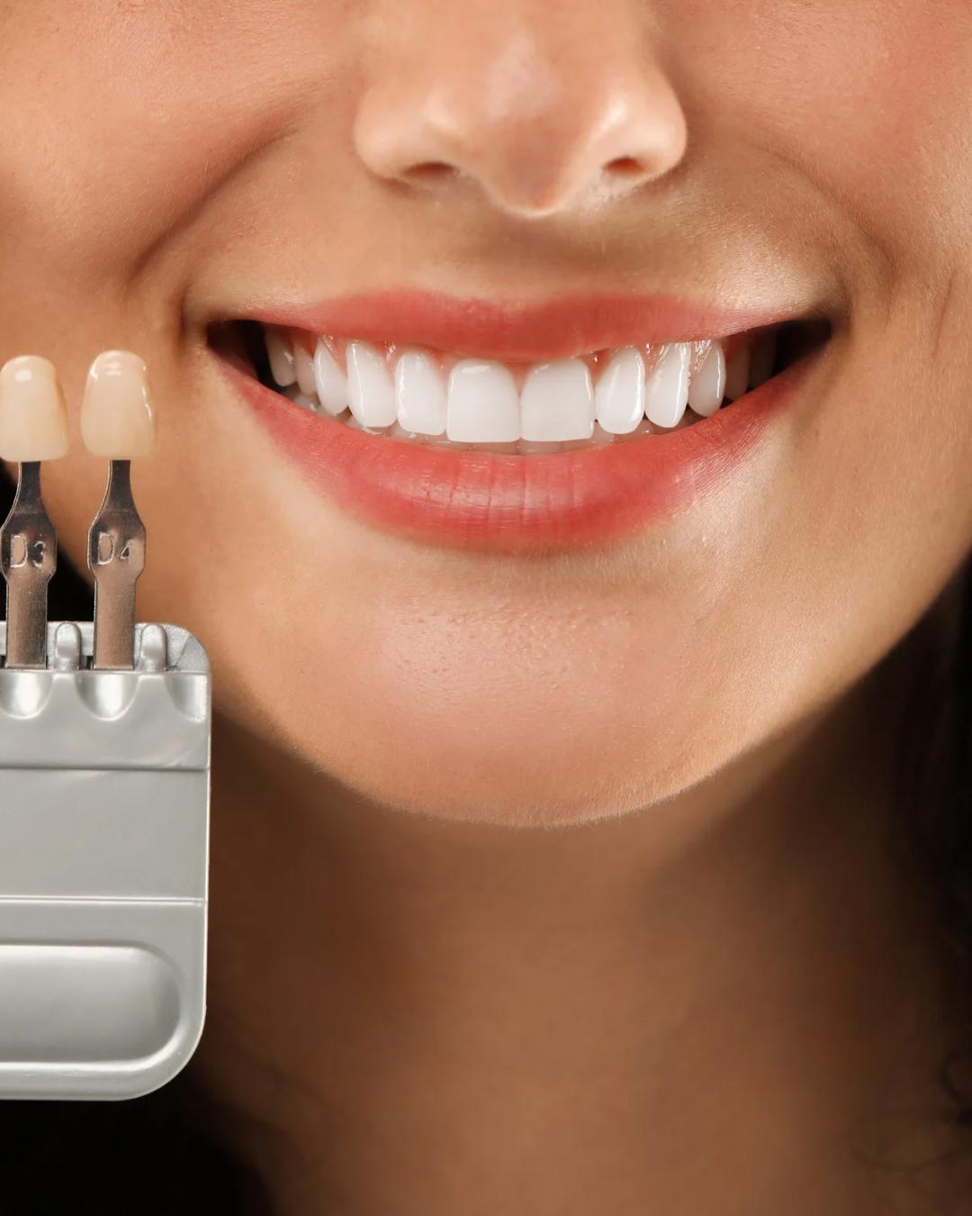 Estética dental y diseño de sonrisa